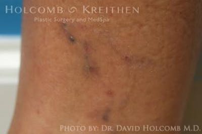 TRL Laser Skin Resurfacing Before & After Gallery - Patient 6279456 - Image 2