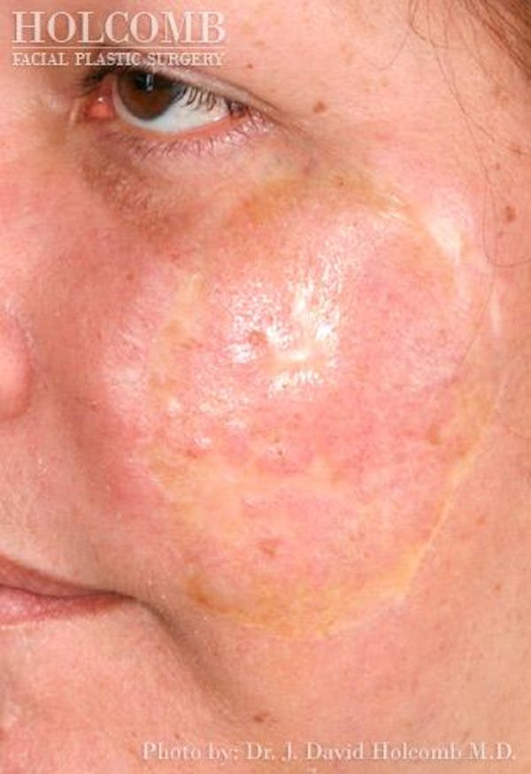TRL Laser Skin Resurfacing Before & After Gallery - Patient 6279460 - Image 1