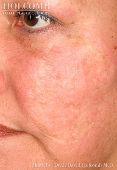 TRL Laser Skin Resurfacing Before & After Gallery - Patient 6279460 - Image 2