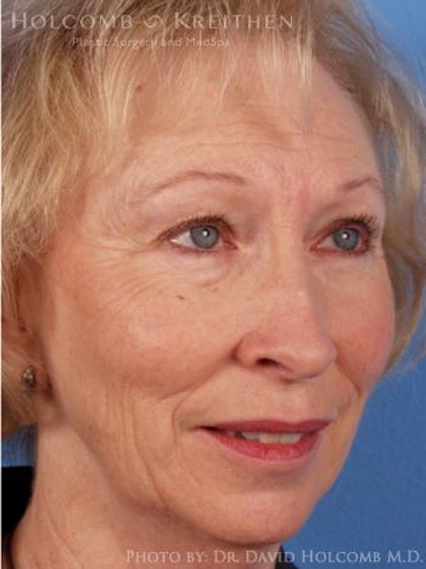 Laser/RF Assisted Facelift Gallery - Patient 6279481 - Image 3