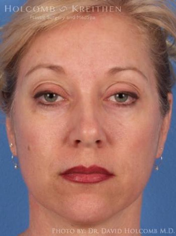 Laser/RF Assisted Facelift Gallery - Patient 6279501 - Image 1