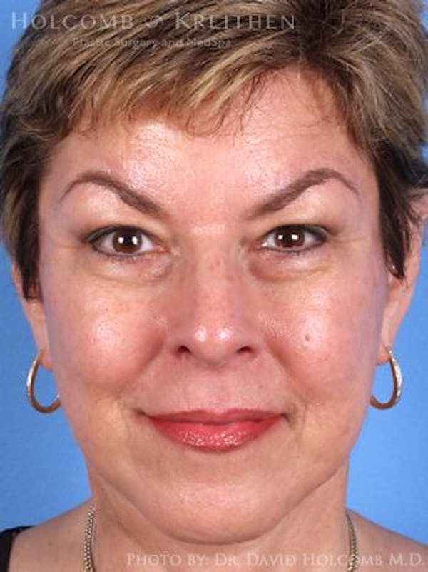 Laser/RF Assisted Facelift Gallery - Patient 6279518 - Image 2