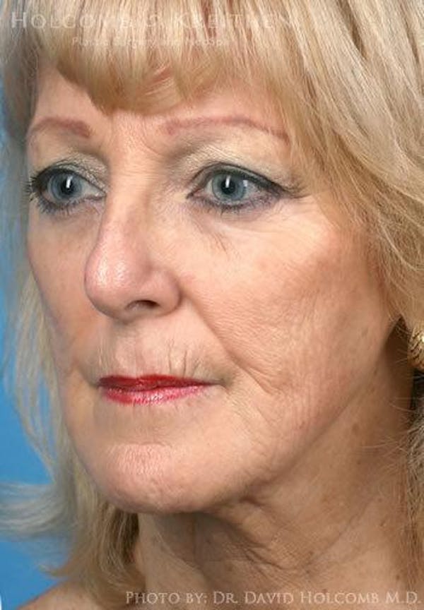 Laser/RF Assisted Facelift Gallery - Patient 6279523 - Image 3