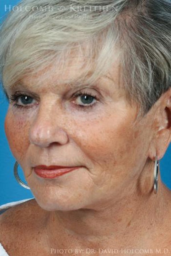 Laser/RF Assisted Facelift Gallery - Patient 6279525 - Image 4