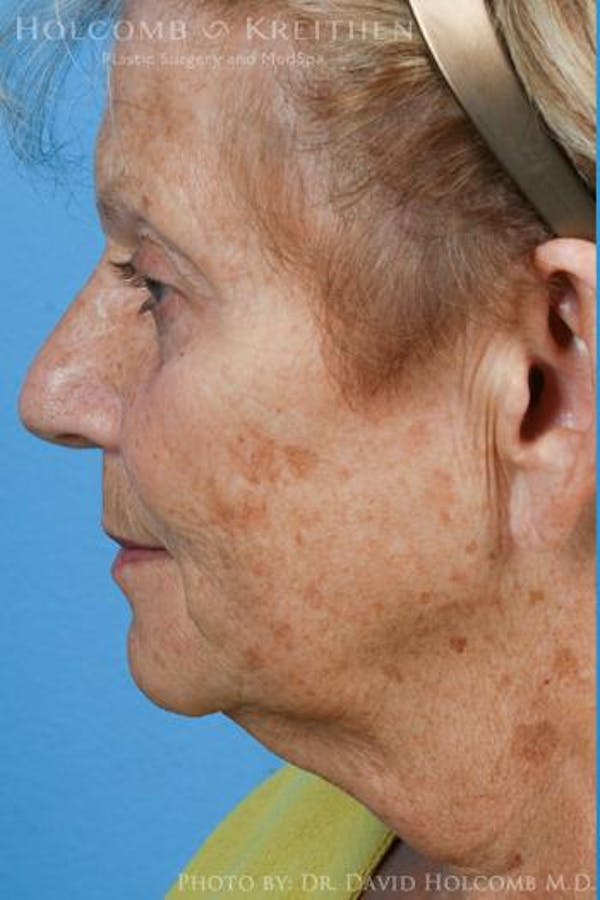 Laser/RF Assisted Facelift Gallery - Patient 6279525 - Image 5