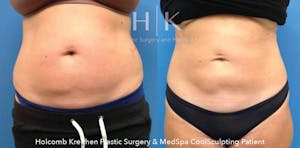 Coolsculpting in Sarasota Before and After Photos