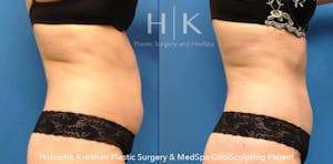 Tampa Coolsculpting Before and After