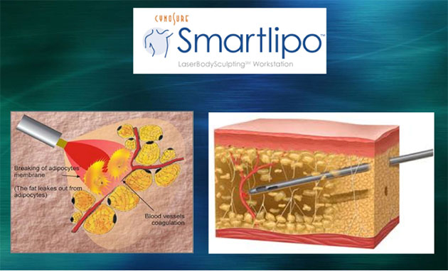 smart lipo of how it works
