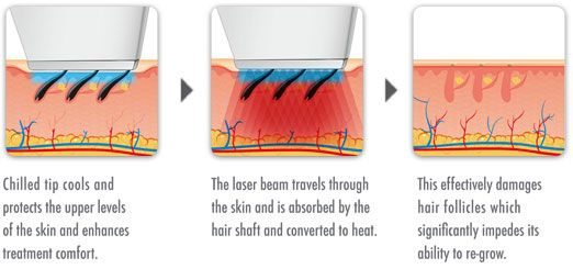 how laser hair removal works infograph