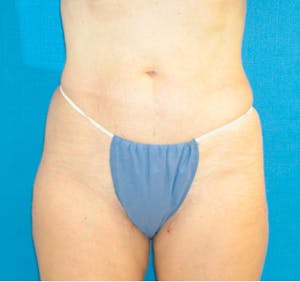 Liposuction