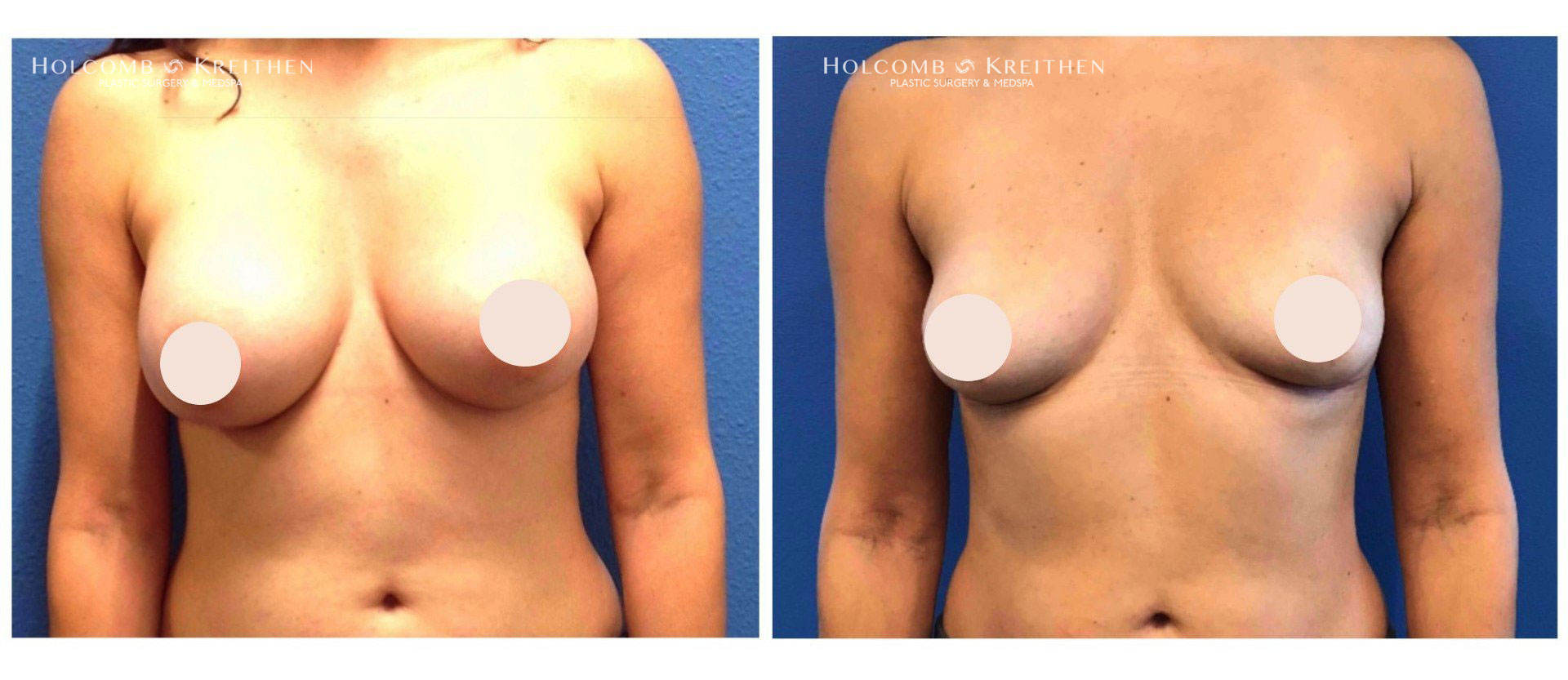 breast augmentation before and after