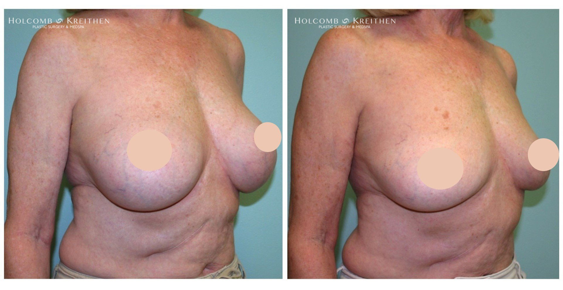 breast augmentation before and after