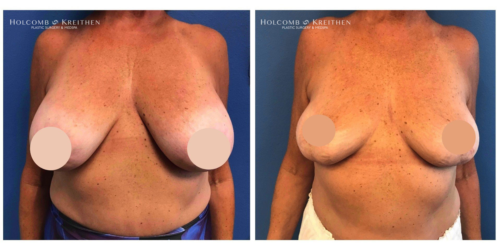 breast augmentation before and after