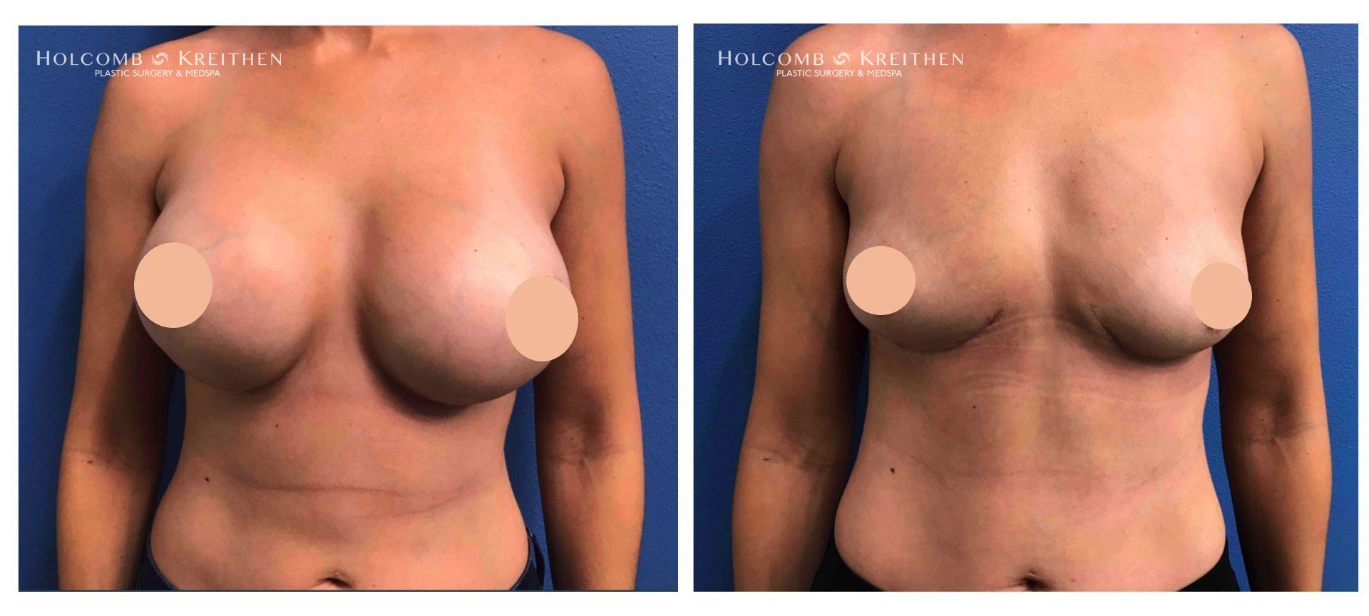 breast augmentation before and after