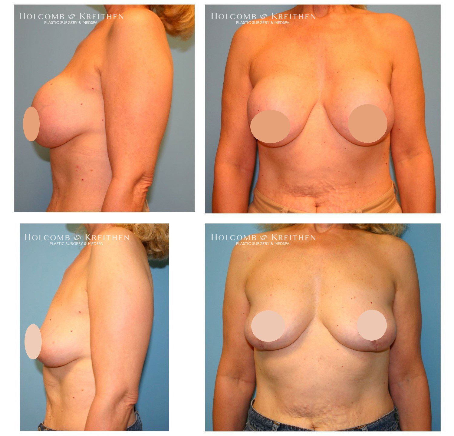 breast augmentation before and after