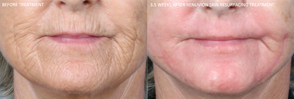 before and after photo of the face after renuvion resurfacing