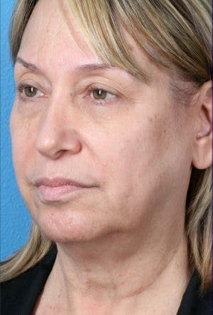 Neck Contouring