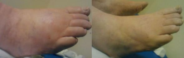 before and after pic of the ankle after using the Hivamat