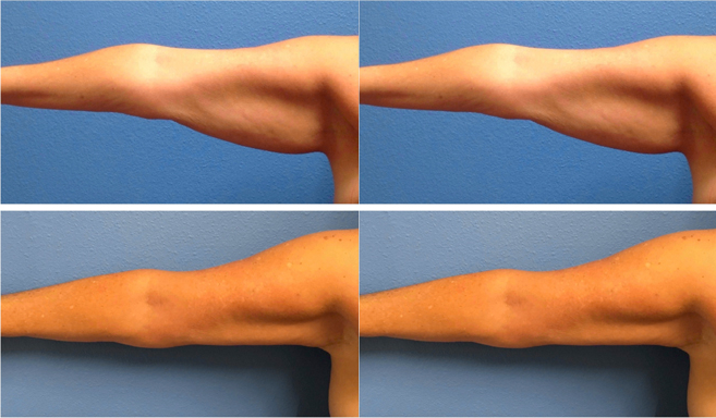 liposuction on the arms before and afters