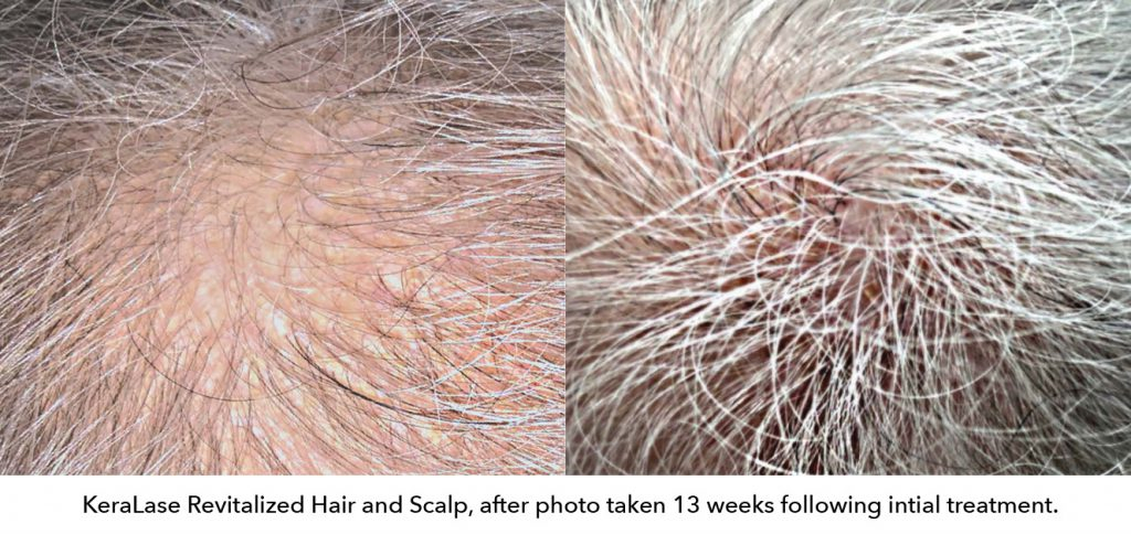 keralase before and after scalp picture
