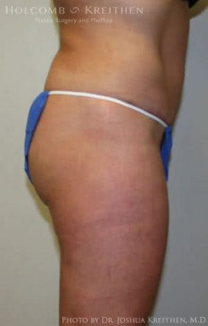 Tummy Tuck in Sarasota & Tampa