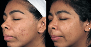 DiamondGlow Before and After