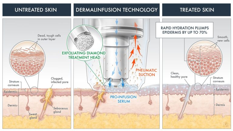 picture of skin being treated with DiamondGlow