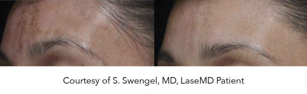 before and after face photos after LaseMD treatment
