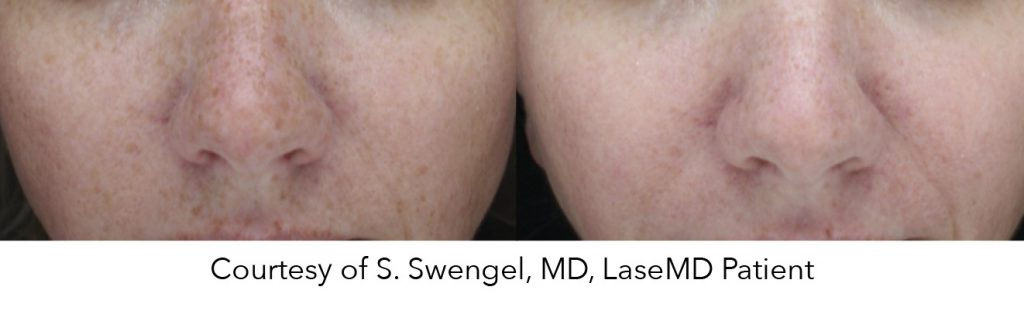 before and after face photos after LaseMD treatment