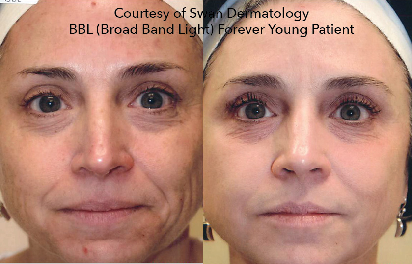 bbl before and after pictures of the face