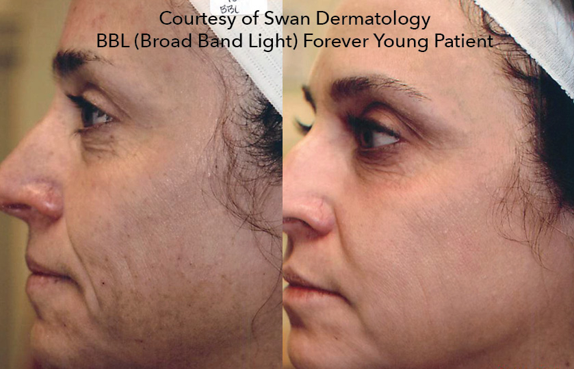 bbl before & after pics of the profile of the face