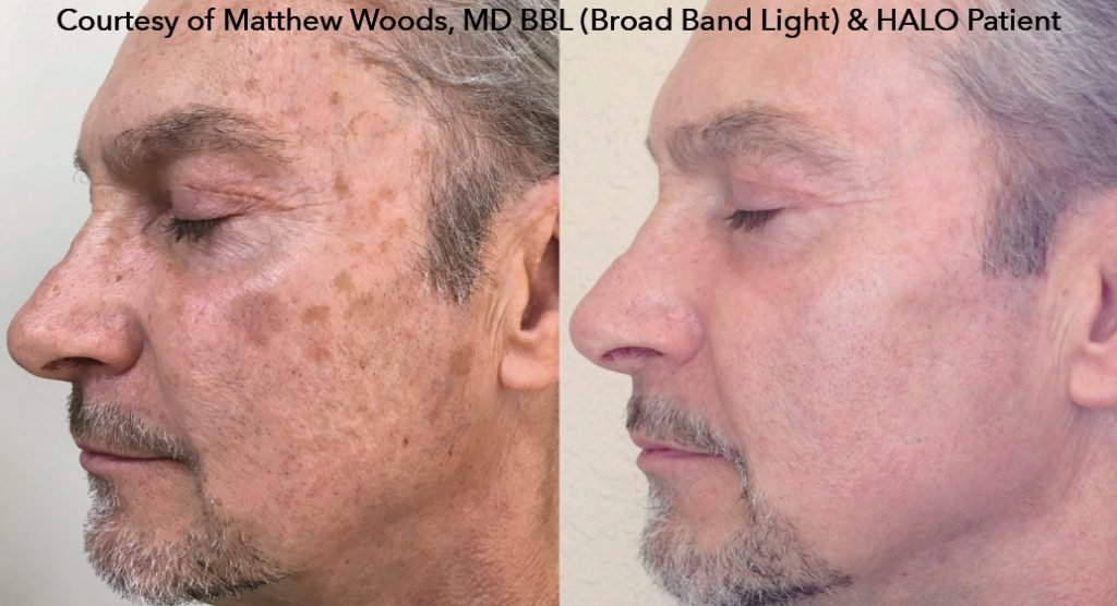 before and after face photos of Halo Hybrid Fractional Laser