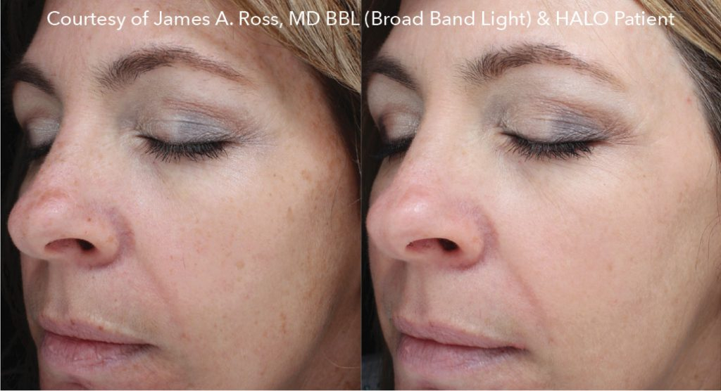 before and after face photos of Halo Hybrid Fractional Laser