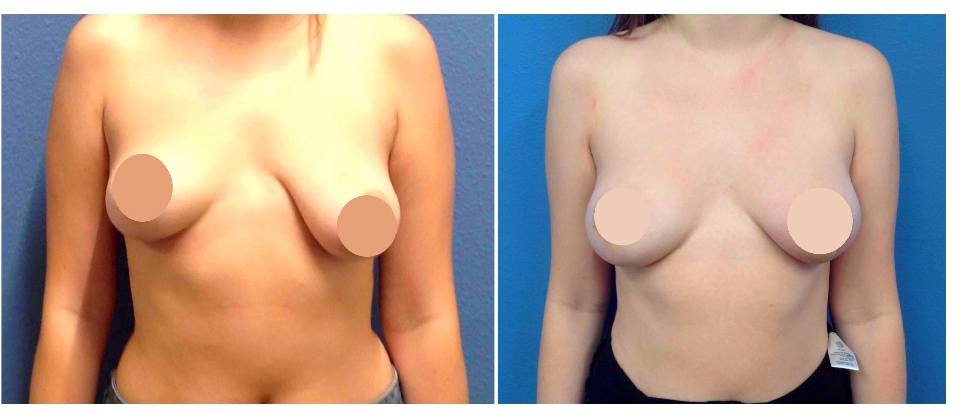 breast lift before and after