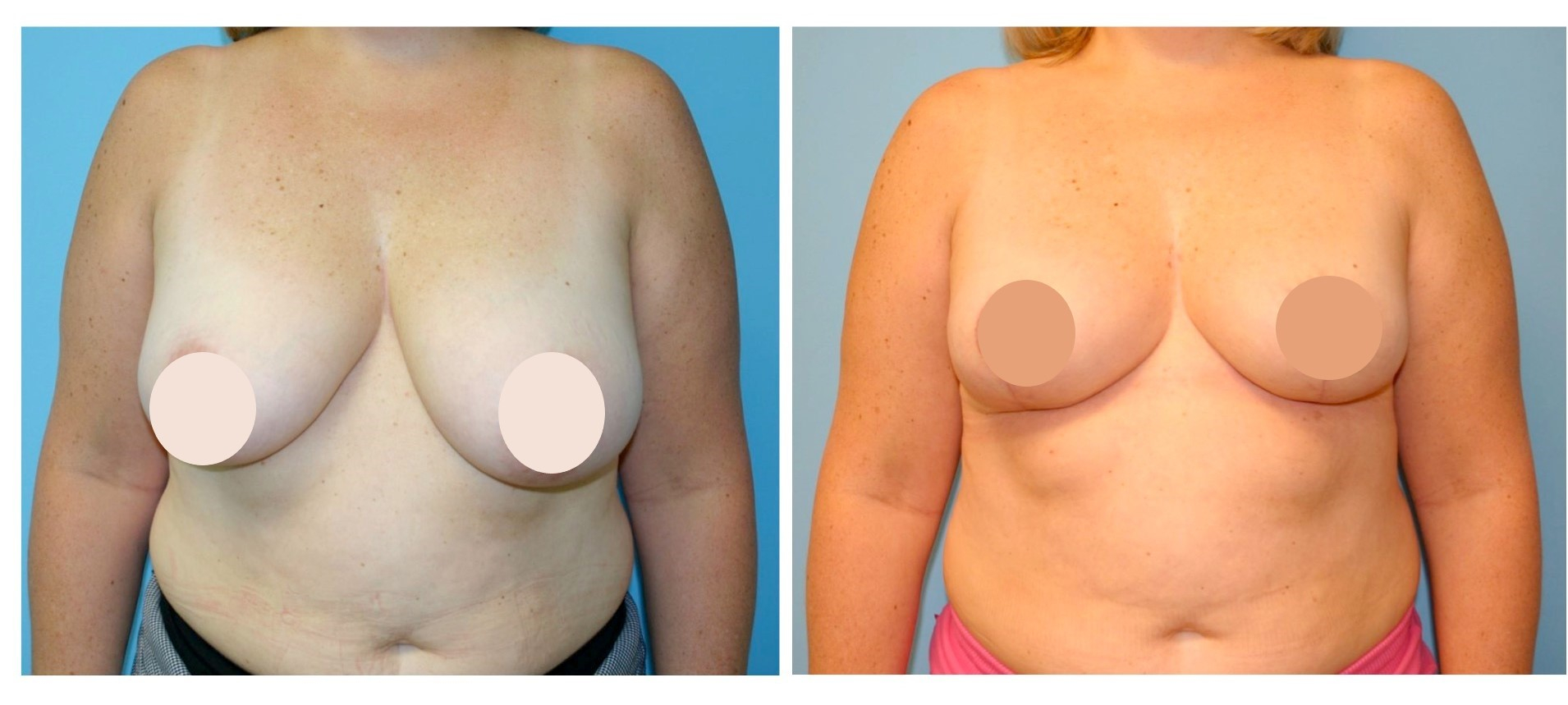 breast lift before and after 