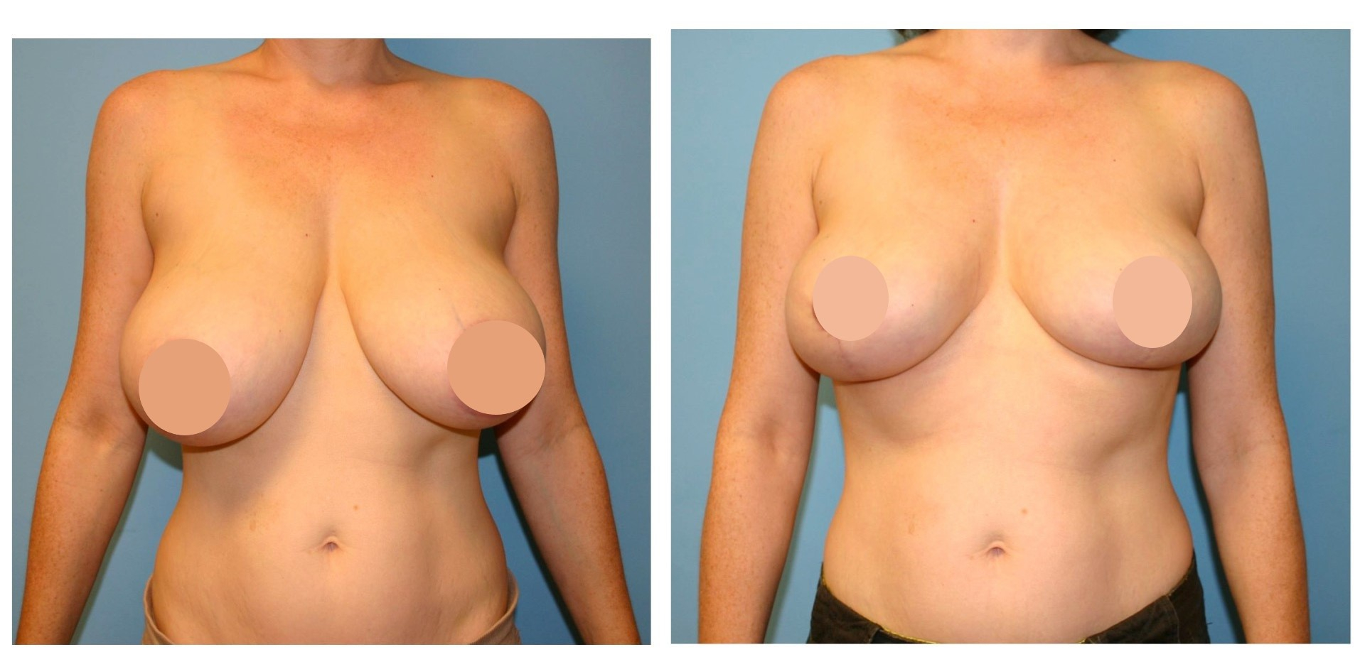 breast lift before and after 