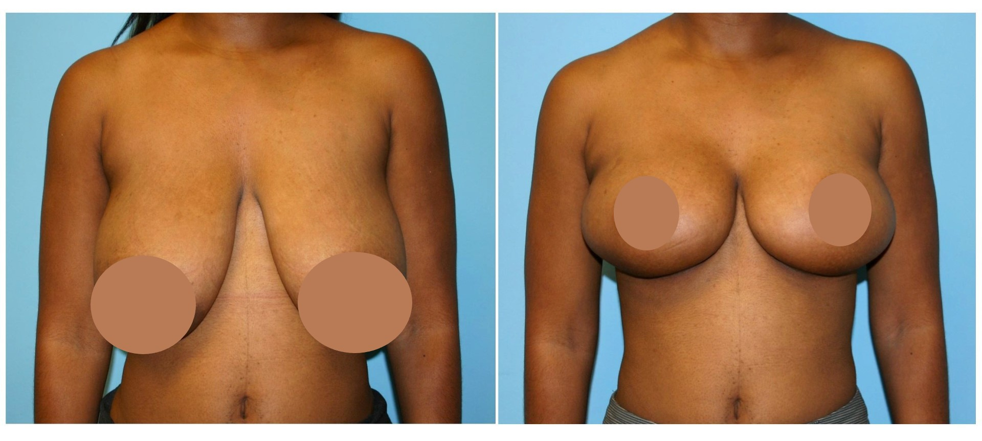 breast lift before and after