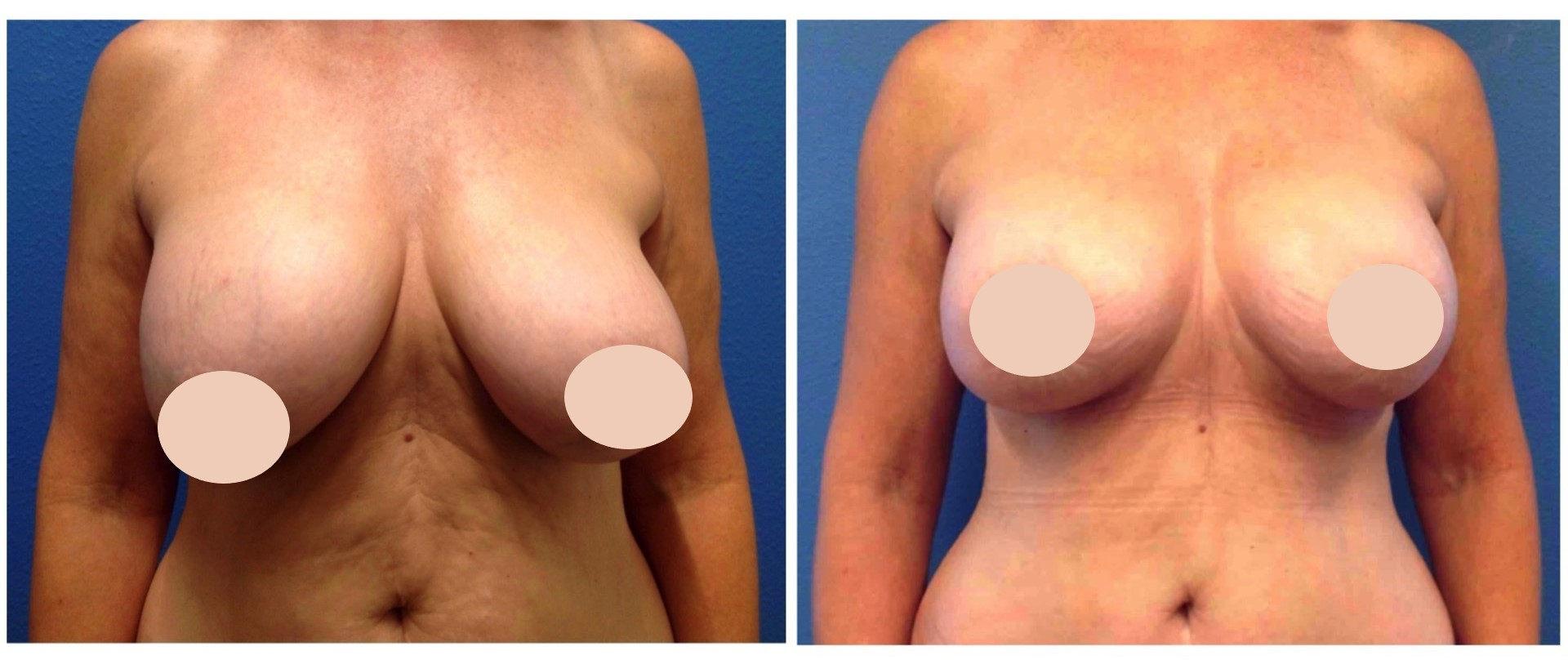 breast lift before and after