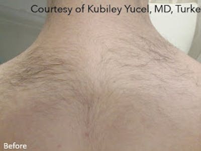 Clarity II Laser Hair Removal Before & After Gallery - Patient 7510135 - Image 1