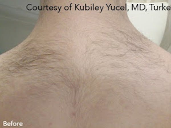 Clarity II Laser Hair Removal Before & After Gallery - Patient 7510135 - Image 1