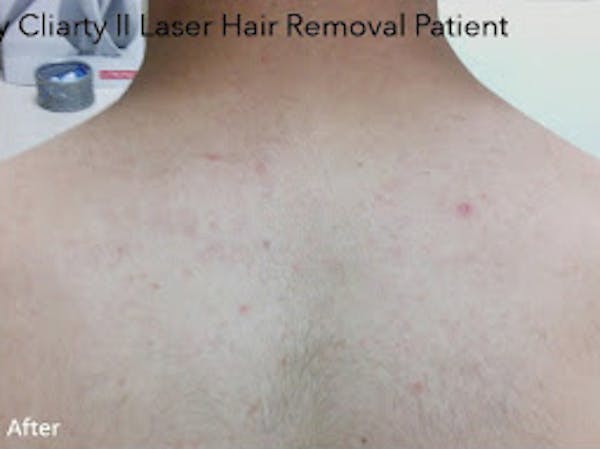 Clarity II Laser Hair Removal Before & After Gallery - Patient 7510135 - Image 2