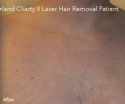Clarity II Laser Hair Removal Before & After Gallery - Patient 7510136 - Image 2