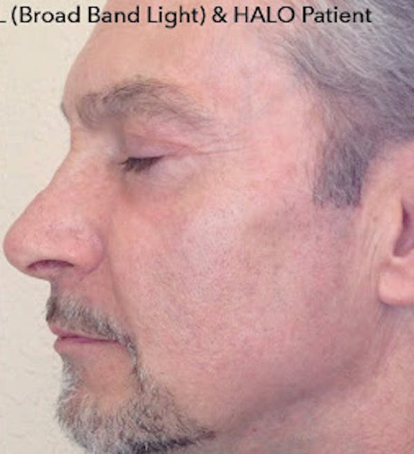   HALO Hybrid Fractional Laser Before & After Gallery - Patient 7510138 - Image 2