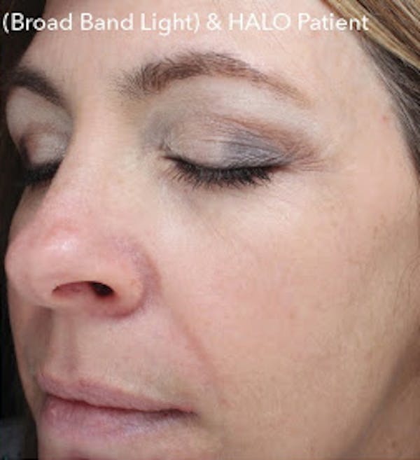   HALO Hybrid Fractional Laser Gallery - Patient 7510139 - Image 2