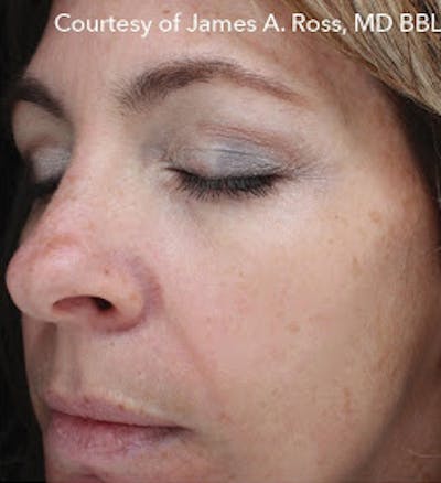   HALO Hybrid Fractional Laser Before & After Gallery - Patient 7510139 - Image 1