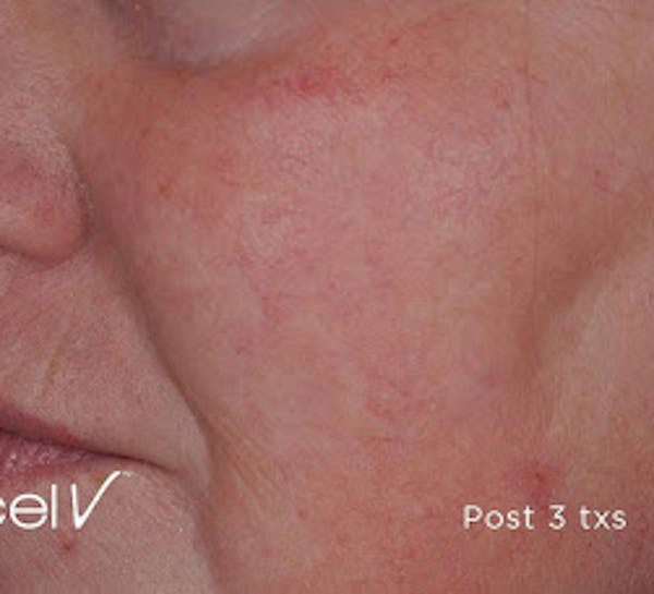 Excel V Vascular Laser Before & After Gallery - Patient 7510142 - Image 2
