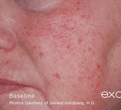 Excel V Vascular Laser Before & After Gallery - Patient 7510142 - Image 1