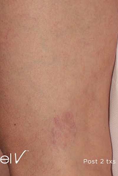 Excel V Vascular Laser Before & After Gallery - Patient 7510143 - Image 2