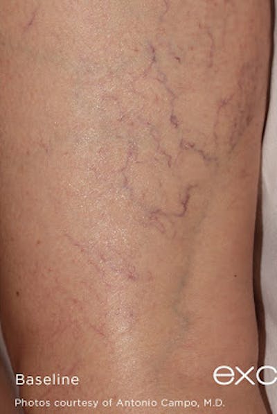 Excel V Vascular Laser Before & After Gallery - Patient 7510143 - Image 1