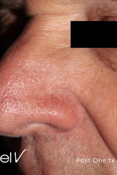 Excel V Vascular Laser Before & After Gallery - Patient 7510144 - Image 2